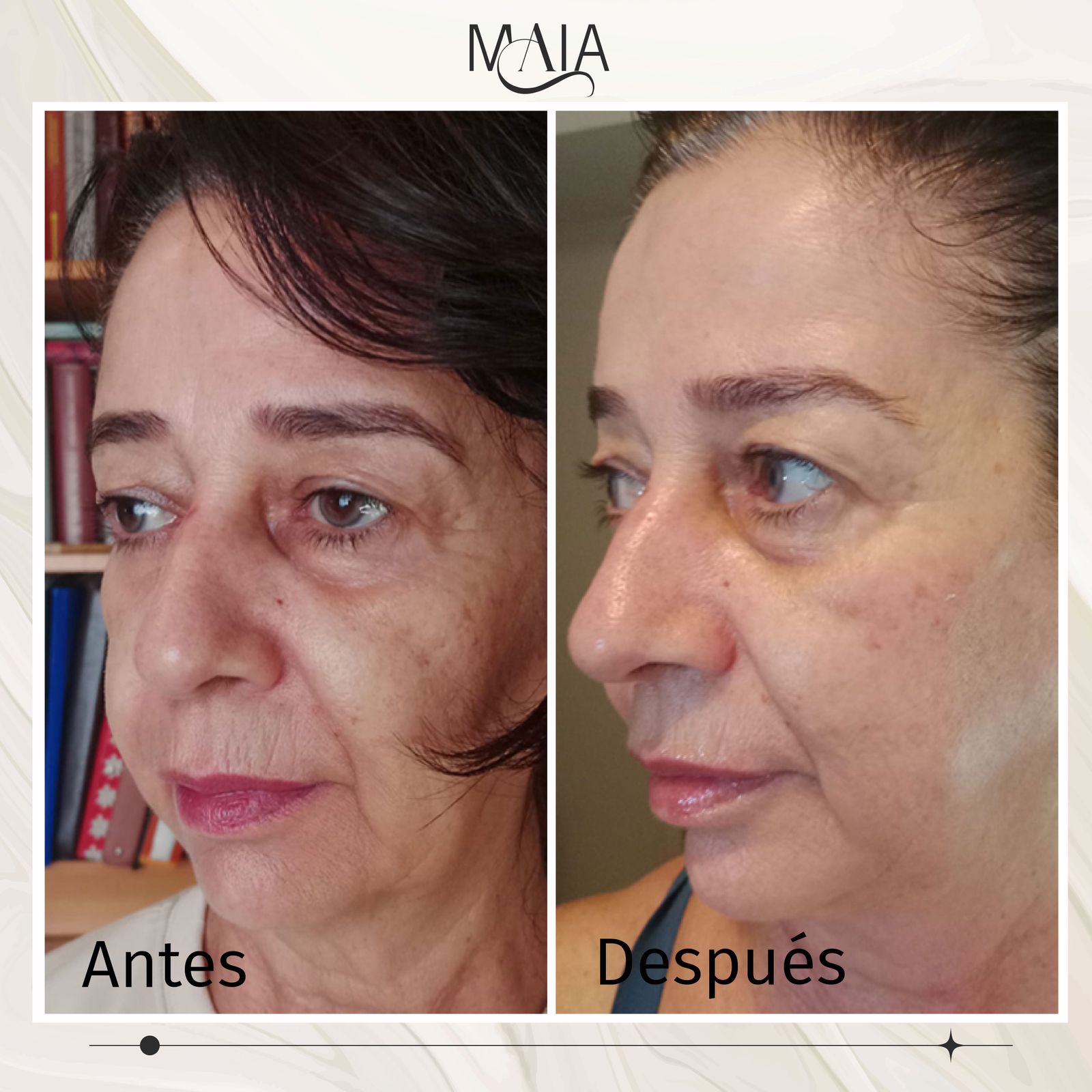 Kobido Lifting Facial - Resultado Gloria - Maia Estética Rivas