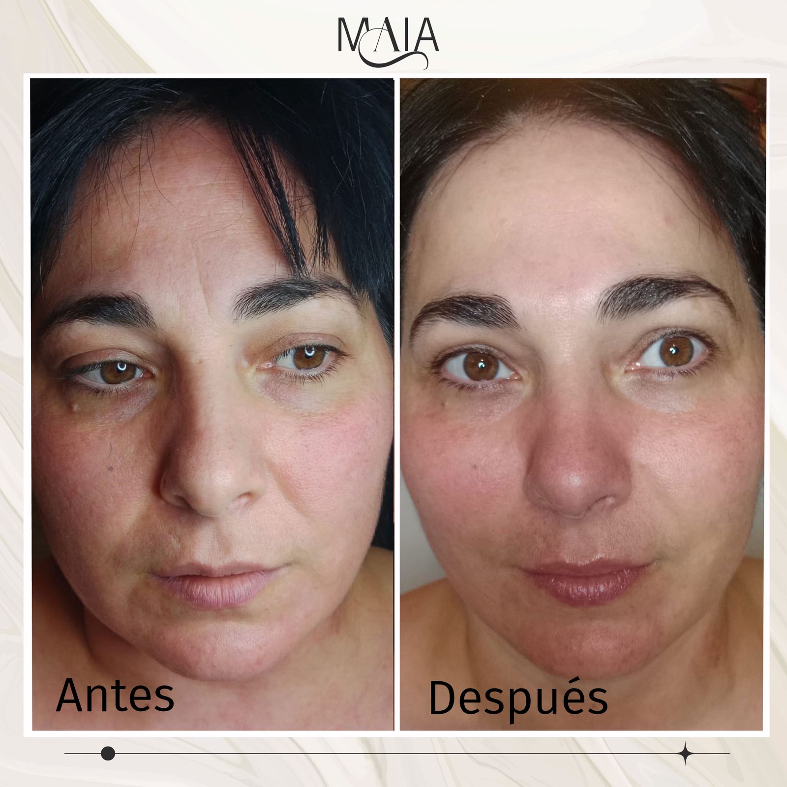 Limpieza Facial - Resultado Maka - Maia Estética Rivas
