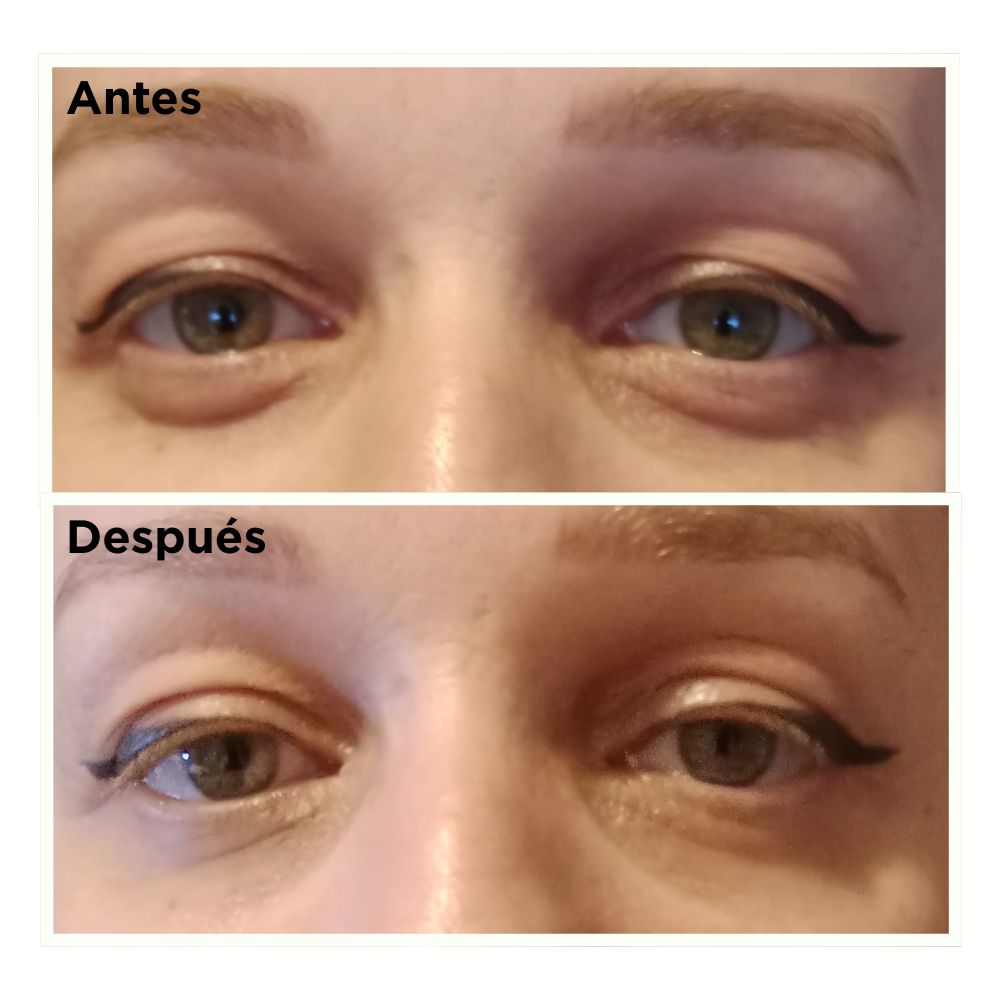 Tratamiento de Mirada - Resultado Bela - Maia Estética Rivas