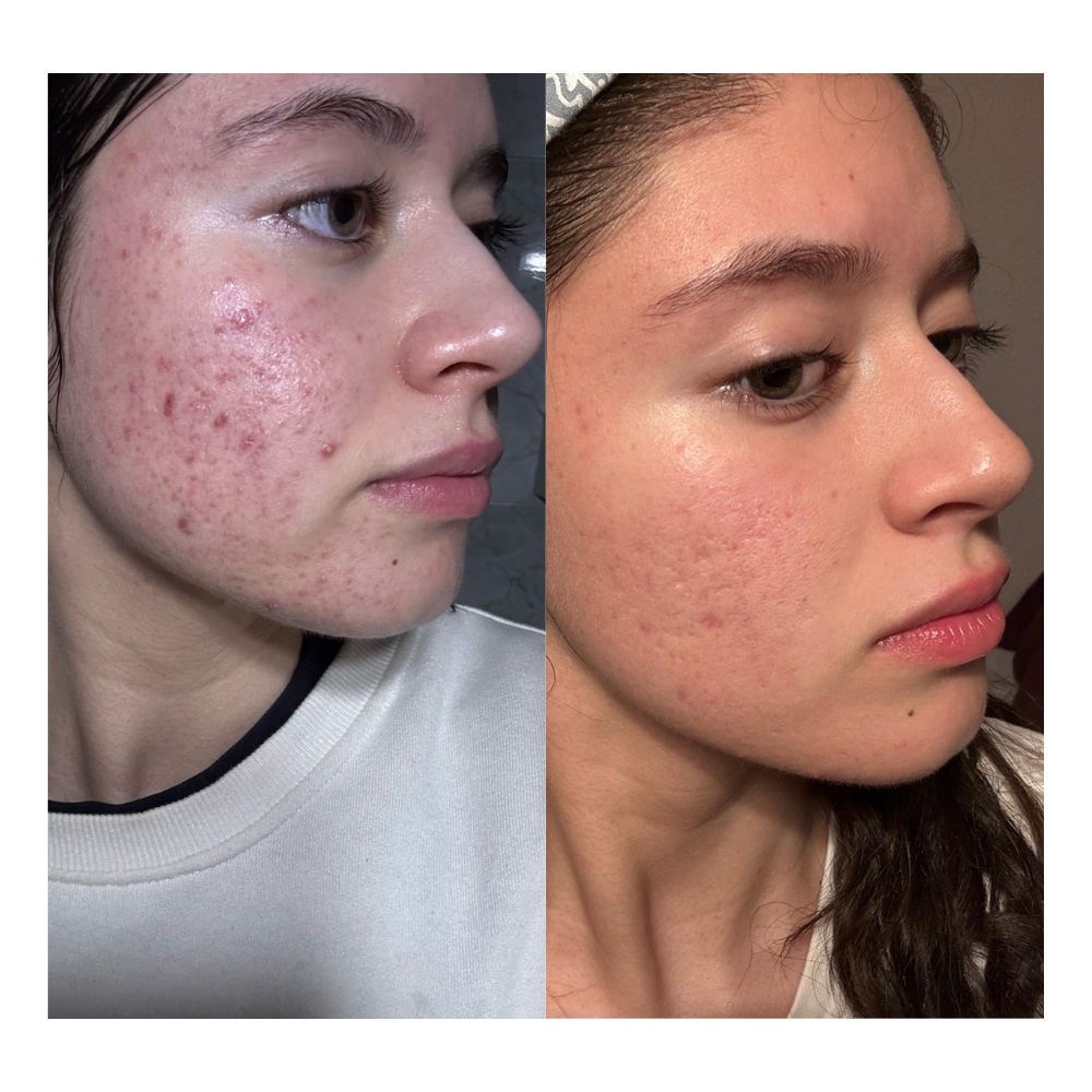 Tratamiento de acné - Resultado Sara - Maia Estética Rivas